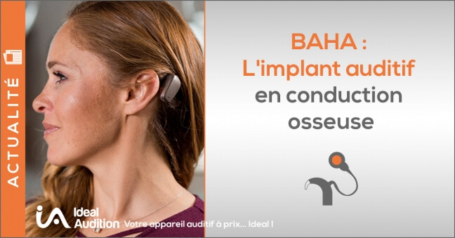 Implant auditif à conduction osseuse BAHA par COCHLEAR