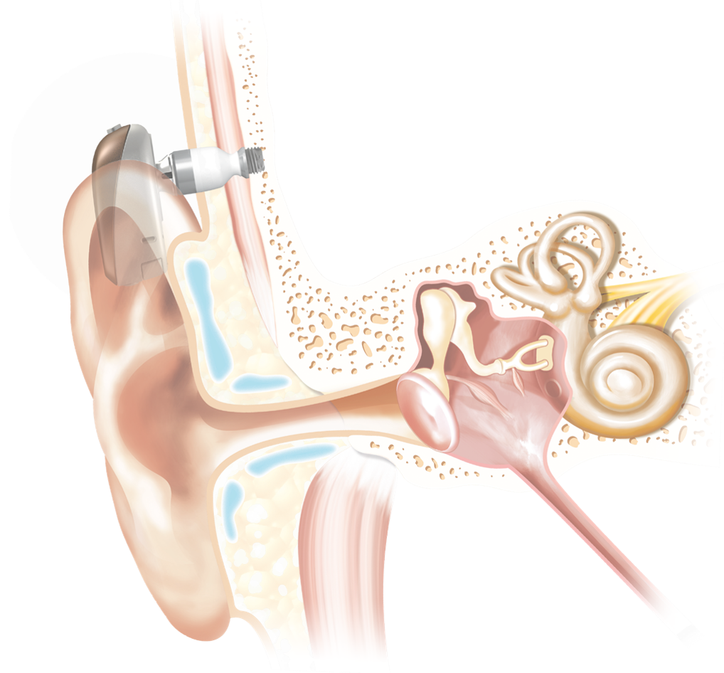 Trucs MAIS PAS Astuce: Les appareils à conduction osseuse - La Solution  Auditive