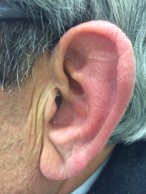 Modèle d'appareil auditif intra auriculaire en photo 