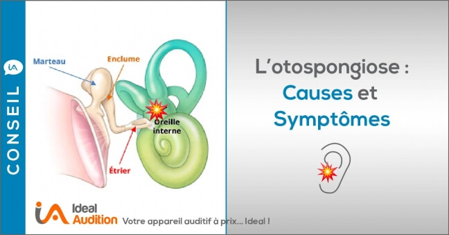 Causes & Symptômes de l'otospongiose 